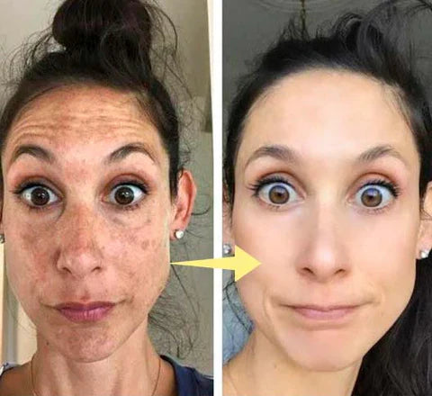 ✨Last Day Discount: 87%OFF-LOVILDS™  Remove freckle Facial Serum