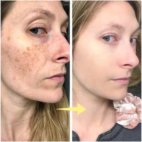 ✨Last Day Discount: 87%OFF-LOVILDS™  Remove freckle Facial Serum