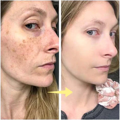 ✨Last Day Discount: 87%OFF-LOVILDS™  Remove freckle Facial Serum