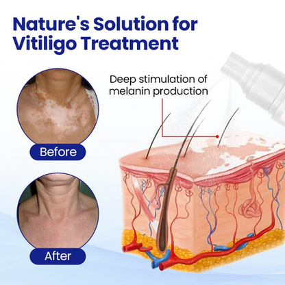 Lovilds® Evenora Vitiligo Herbal Spray