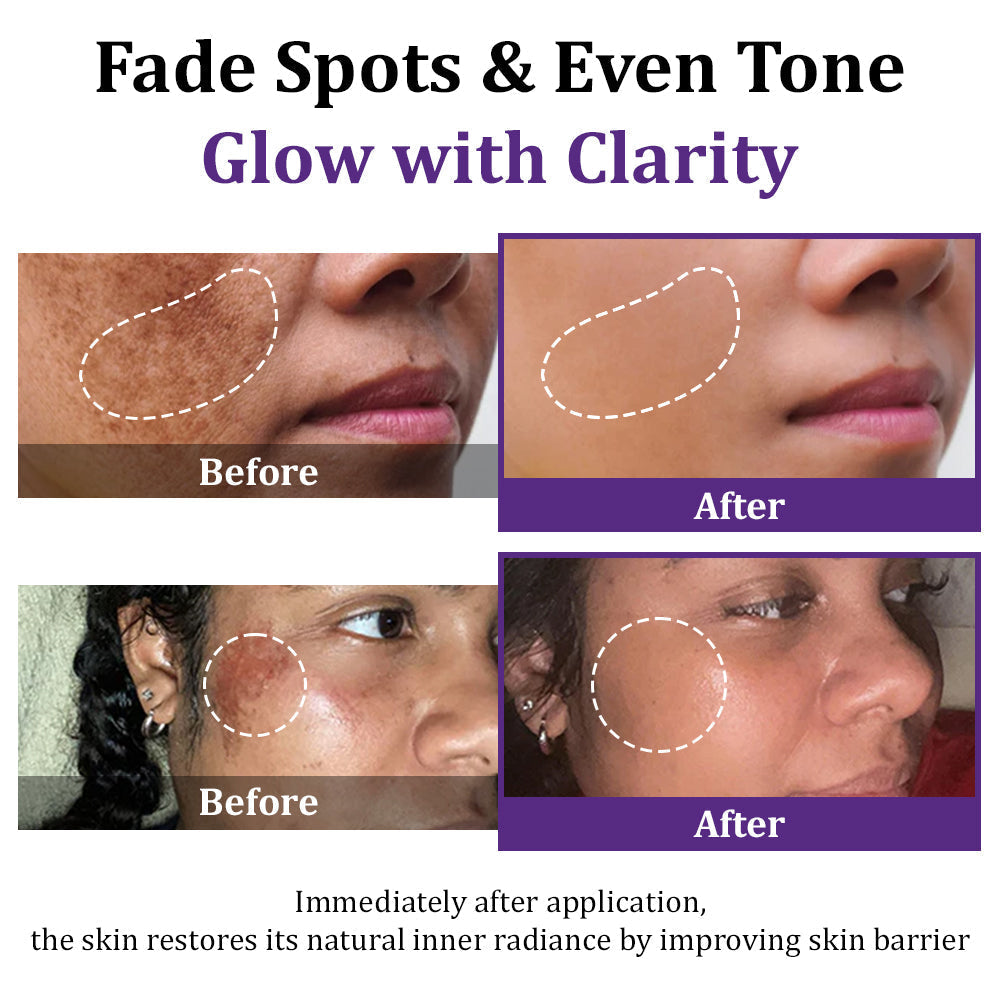 𝐋𝐎𝐕𝐈𝐋𝐃𝐒™ 𝐄𝐏𝐈𝐆𝐋𝐎𝐖 𝐀𝐝𝐯𝐚𝐧𝐜𝐞𝐝 𝐂𝐫𝐞𝐚𝐦 – Clinically designed to correct skin pigmentation