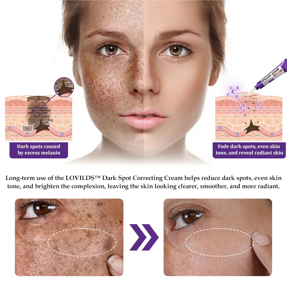 𝐋𝐎𝐕𝐈𝐋𝐃𝐒™ 𝐄𝐏𝐈𝐆𝐋𝐎𝐖 𝐀𝐝𝐯𝐚𝐧𝐜𝐞𝐝 𝐂𝐫𝐞𝐚𝐦 – Clinically designed to correct skin pigmentation